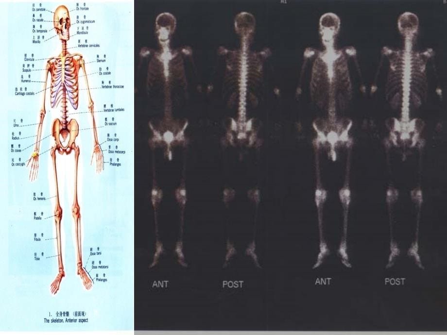 骨骼核医学讲稿PPT专业课件.ppt_第5页