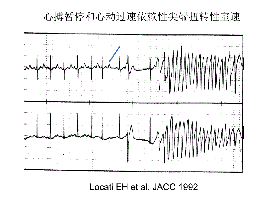 心搏暂停和心动过速依赖性尖端扭转性室速ppt课件.ppt_第1页