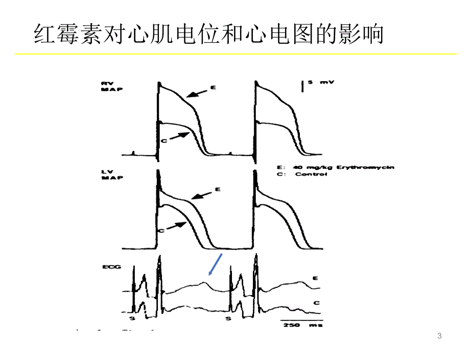 心搏暂停和心动过速依赖性尖端扭转性室速ppt课件.ppt_第3页