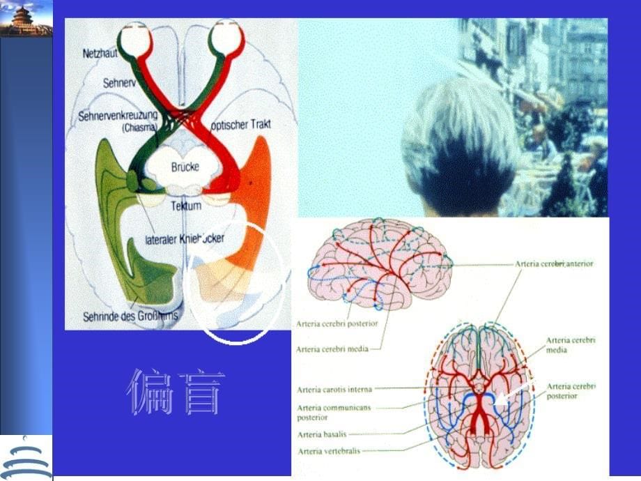 脑动脉粥样硬化的诊断与治疗策略_第5页