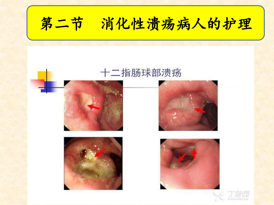 消化性溃疡病人的护理89500PPT课件.ppt_第1页