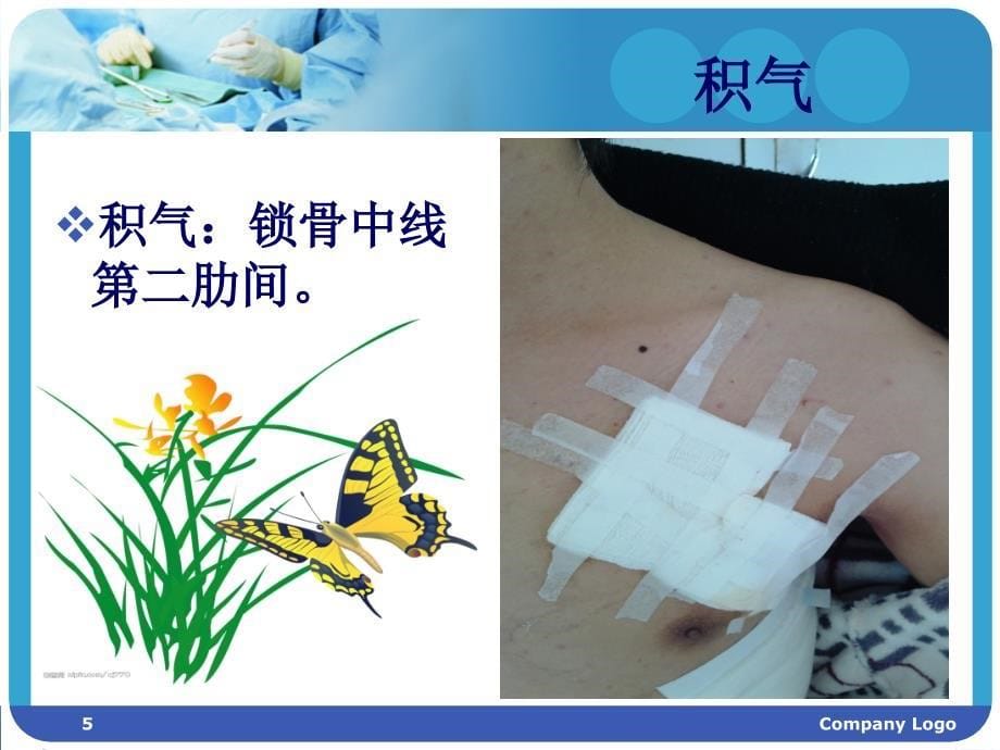 胸腔闭式引流护理PPT课件.ppt_第5页