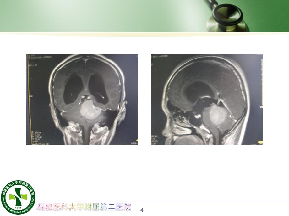 脑室外引流讲课简介PPT课件.ppt_第4页