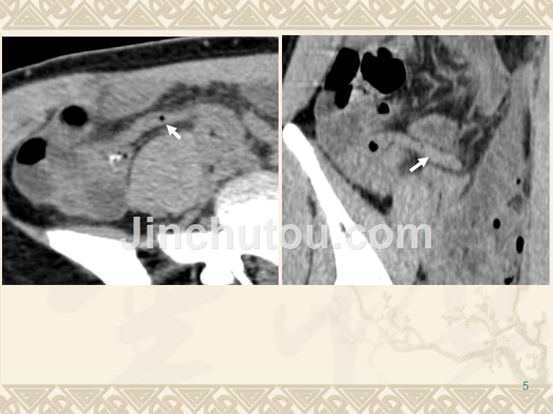急性阑尾炎CT表现精品PPT课件.ppt_第5页