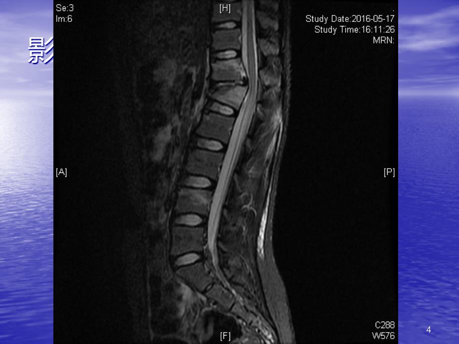 教学查房-腰椎骨折PPT课件.ppt_第4页