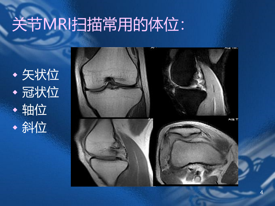 名师推荐MRI骨关节影像诊断PPT课件.ppt_第4页