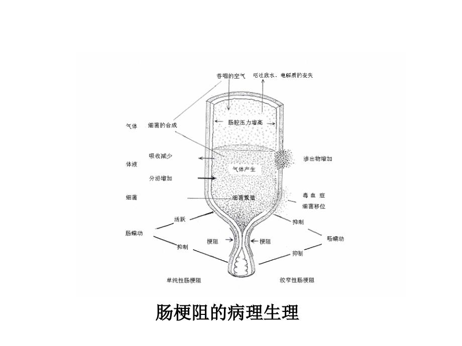 肠梗阻诊断PPT课件.ppt_第4页