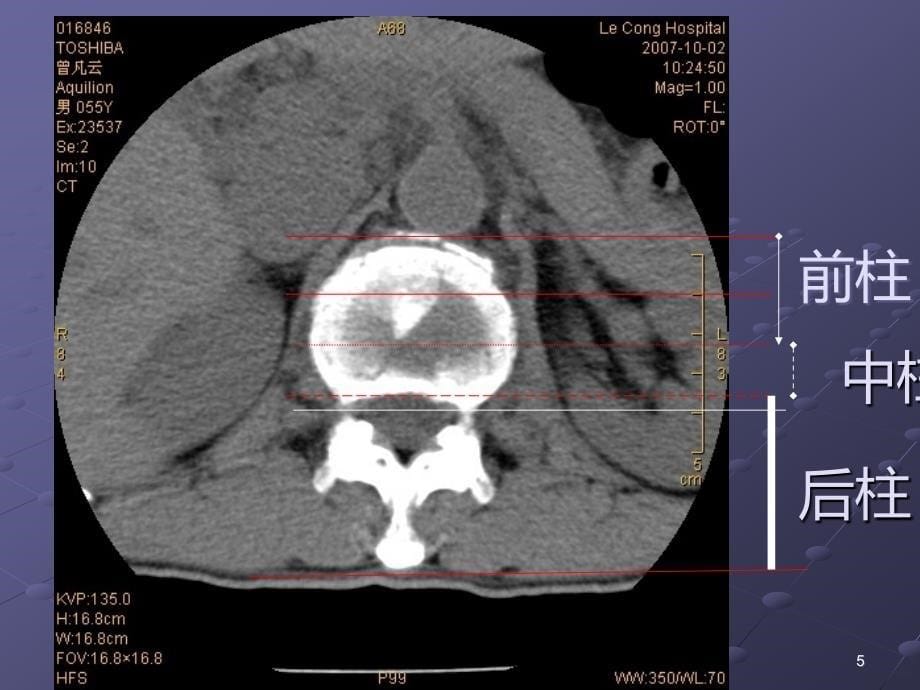 胸腰椎爆裂性骨折的影像学诊断PPT课件.ppt_第5页