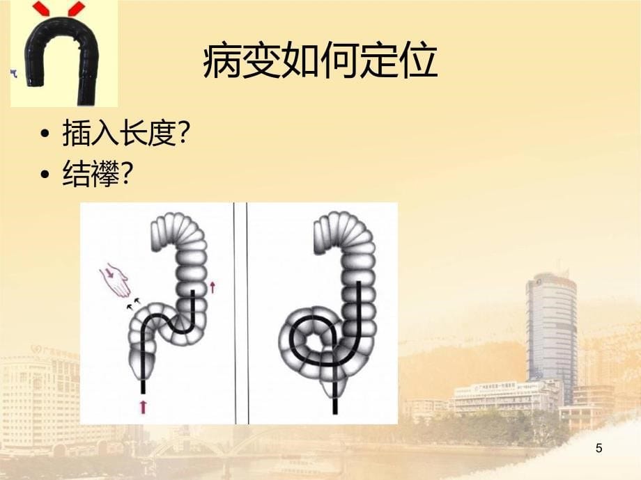 进修心得：肠镜诊疗应知的那些事儿PPT课件.ppt_第5页