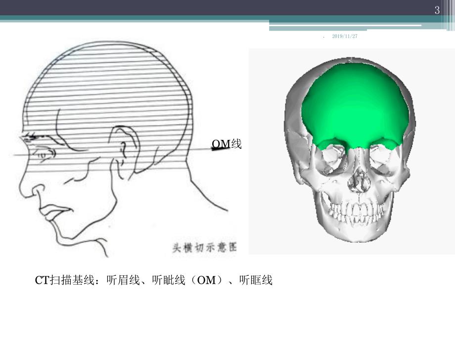 头颅CT断层解剖PPT课件.ppt_第3页