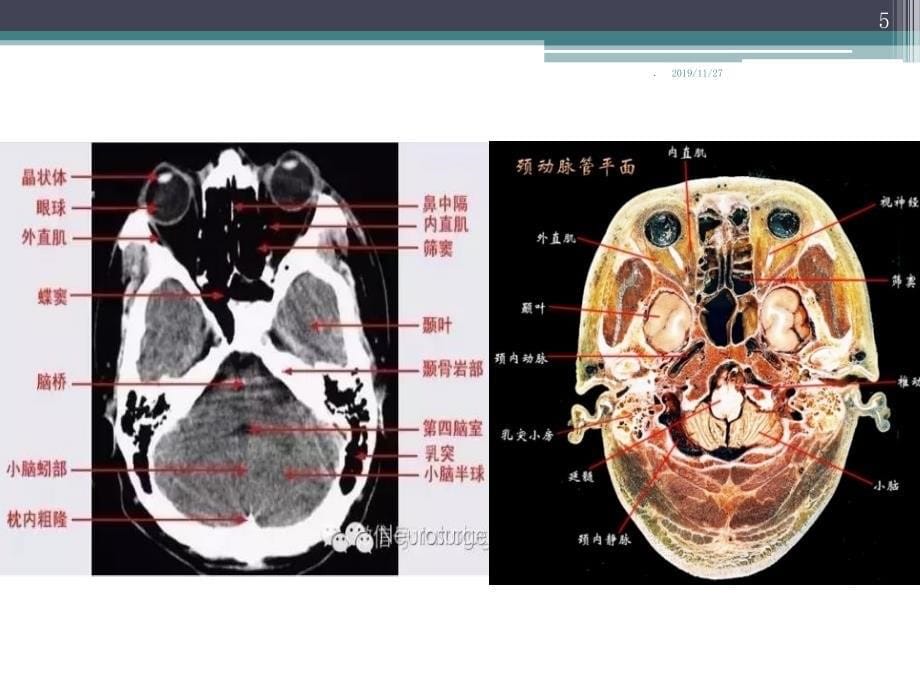 头颅CT断层解剖PPT课件.ppt_第5页