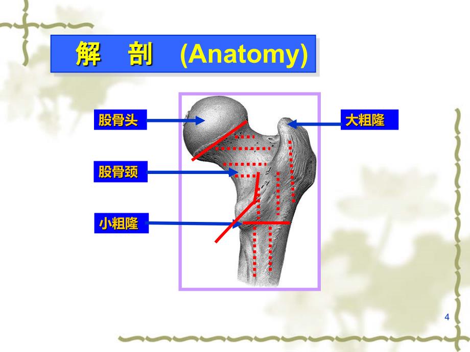 股骨颈骨折的护理PPT课件.ppt_第4页