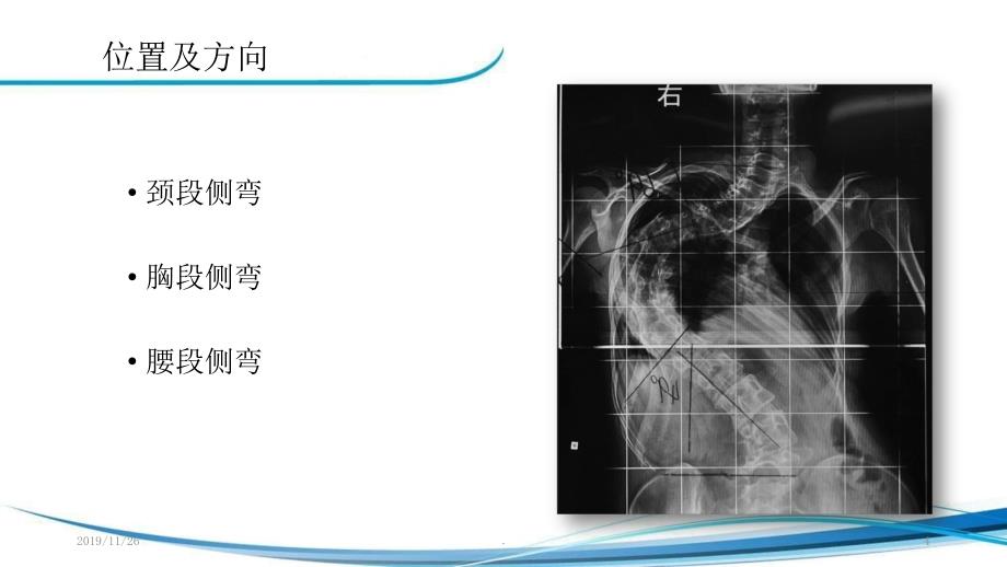 脊柱侧弯手术的麻醉PPT课件.ppt_第4页