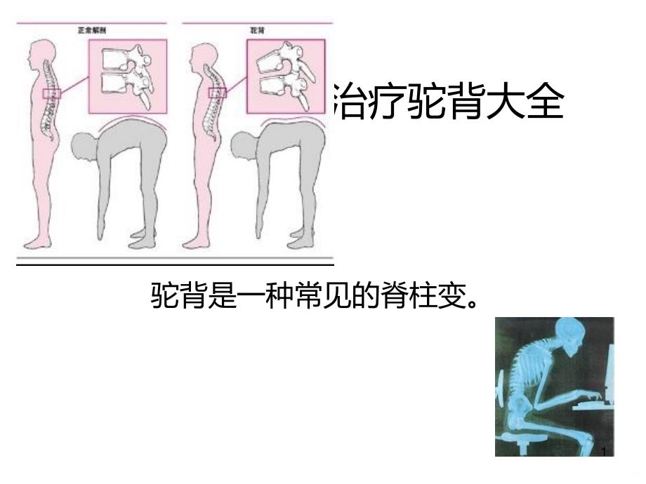 青少年告别驼背PPT课件.ppt_第1页