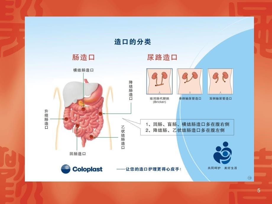 造口并发症护理PPT课件.ppt_第5页