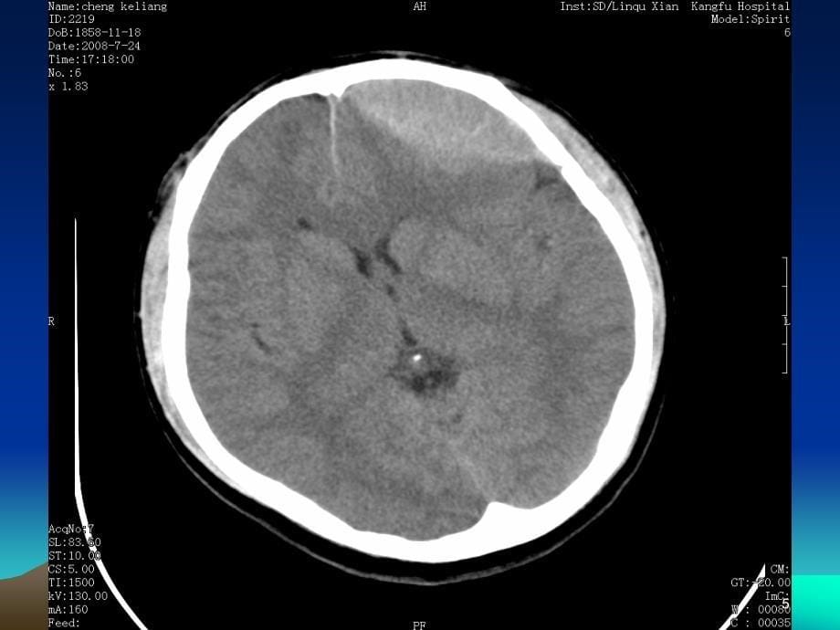 常见颅脑外伤的CT诊断PPT课件.ppt_第5页