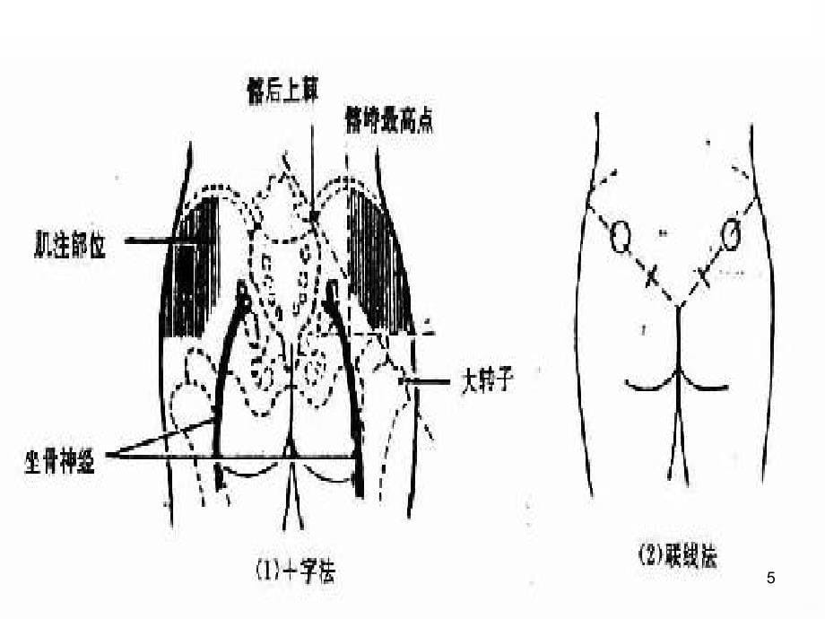 肌肉注射PPT课件.ppt_第5页