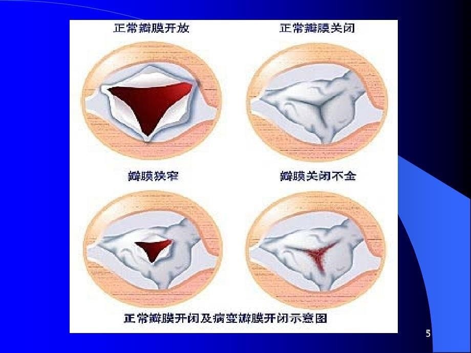 心脏瓣膜病及术后监护-文档PPT课件.ppt_第5页