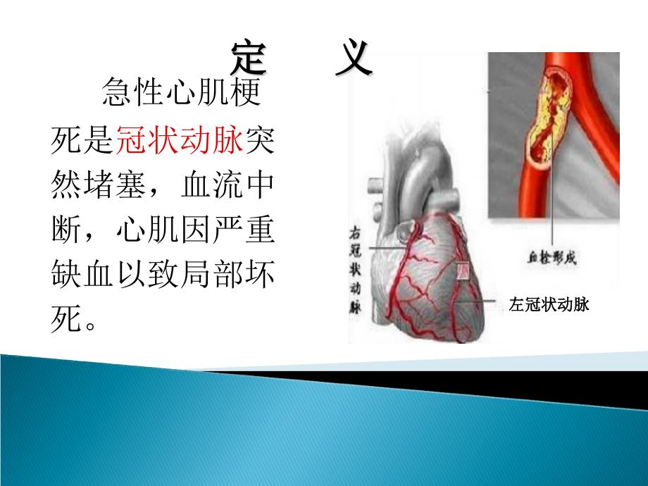 急性心肌梗死73950PPT课件.ppt_第2页