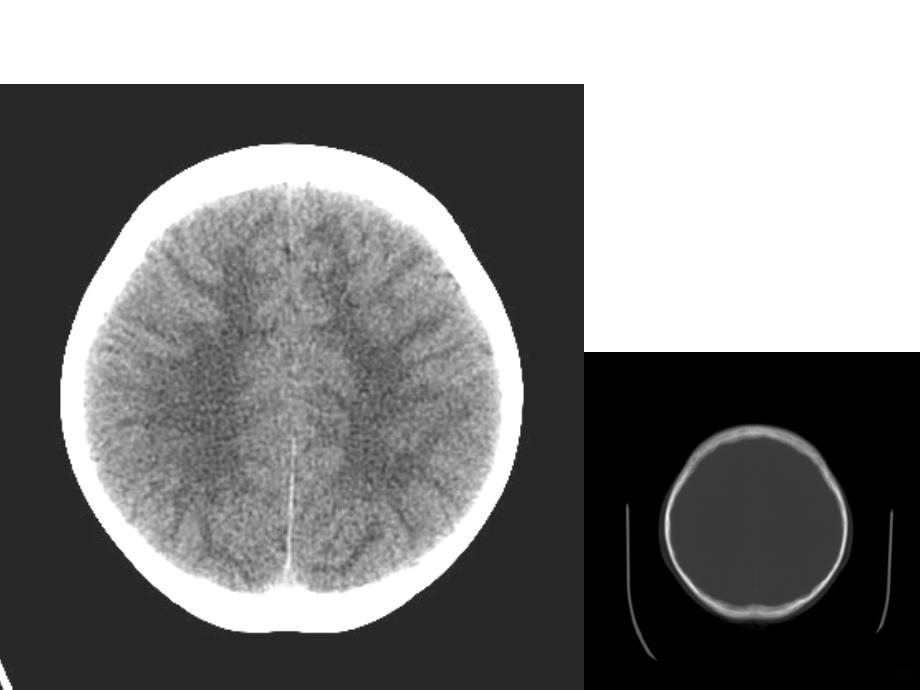 正常脑ctPPT课件.ppt_第3页