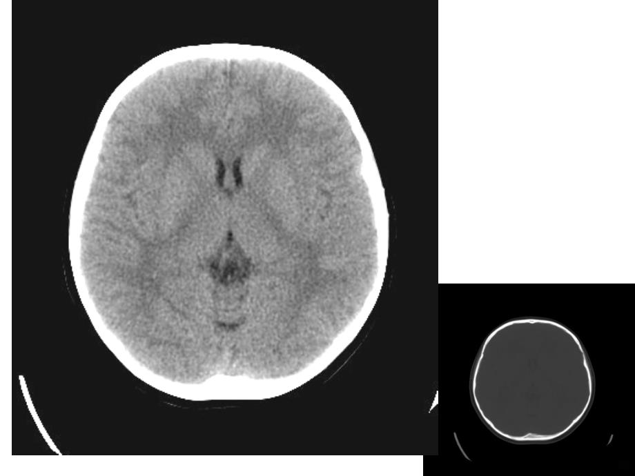 正常脑ctPPT课件.ppt_第4页