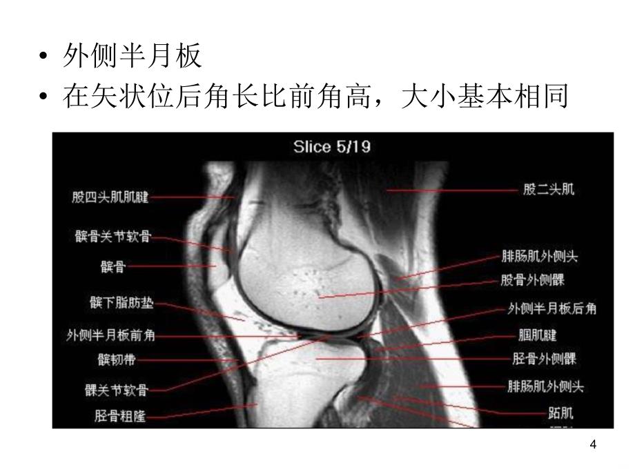 半月板的影像学表现PPT课件.ppt_第4页