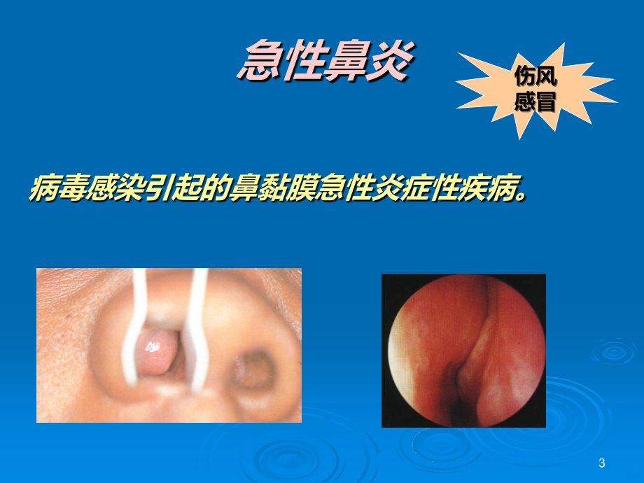 急慢性鼻炎PPT课件.ppt_第3页