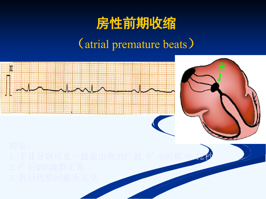常见心律失常的ECG表现及医药物治疗_第3页