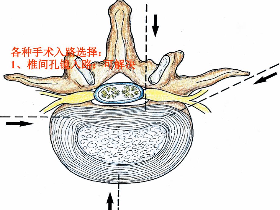 椎间孔镜技术的历史及现状----医生介绍版_第2页