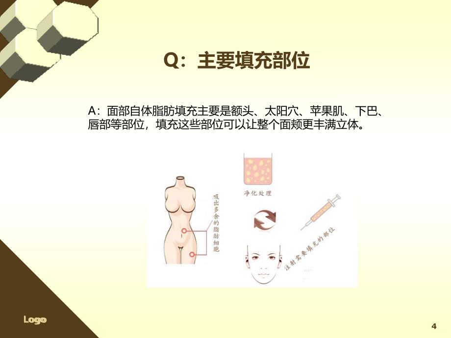 面部自体脂肪填充PPT课件.ppt_第4页