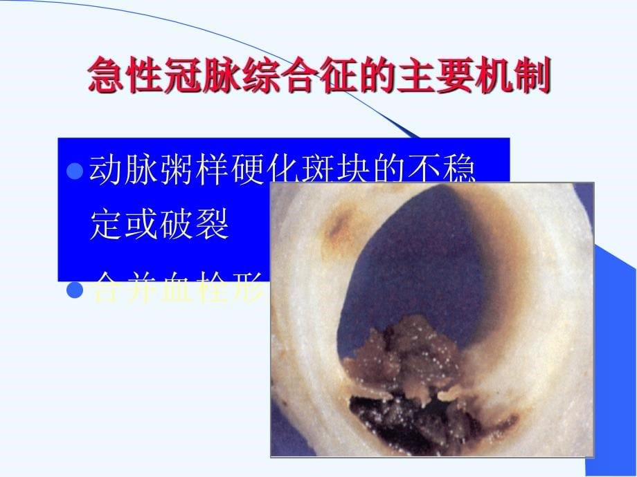 ACS危险分层以及处理策略ppt_第5页