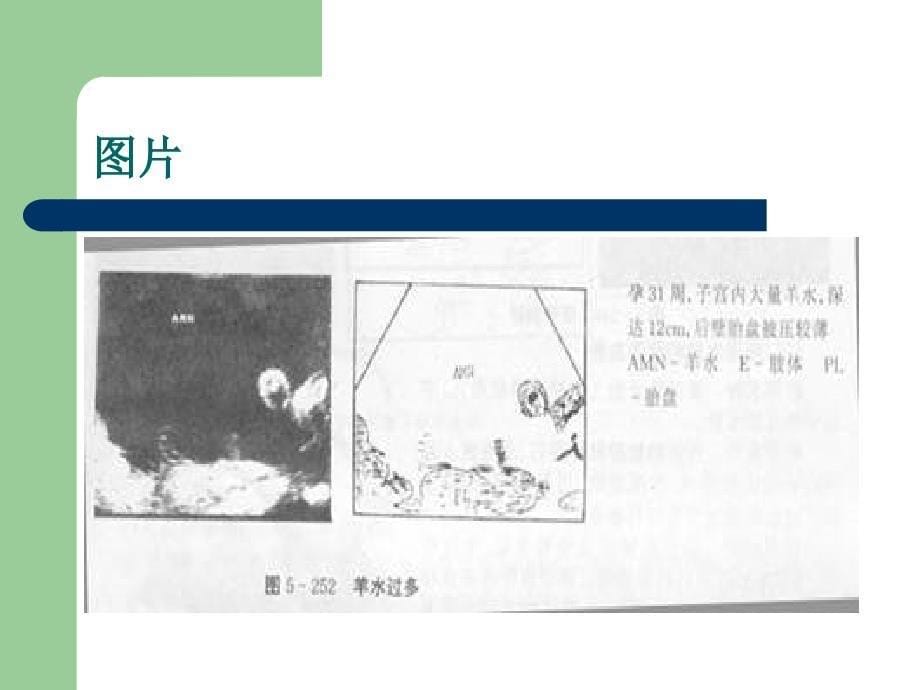 羊水异常最新版.ppt_第5页