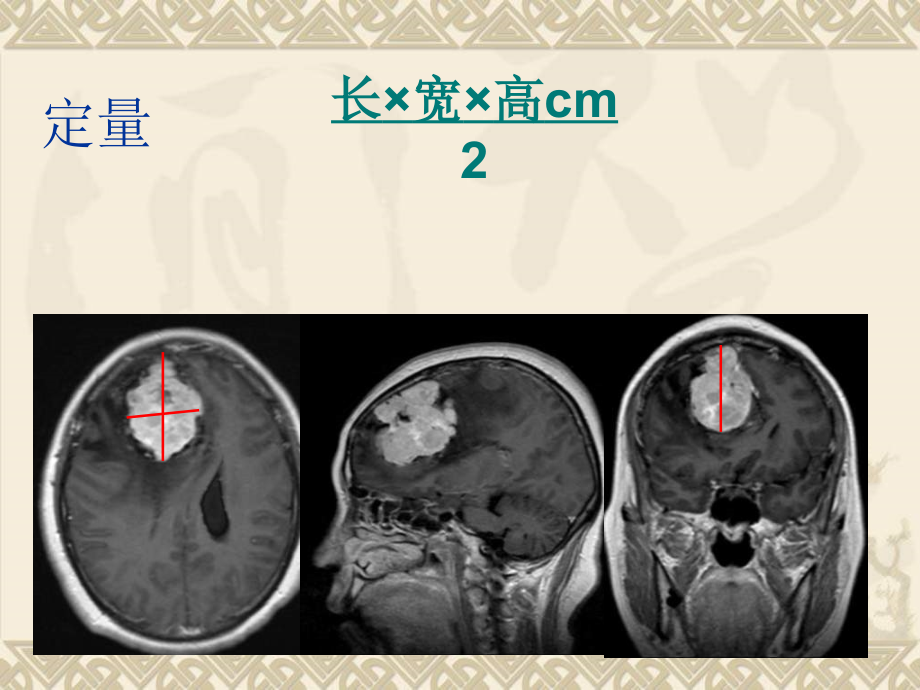 中枢神经系统MRI_第4页