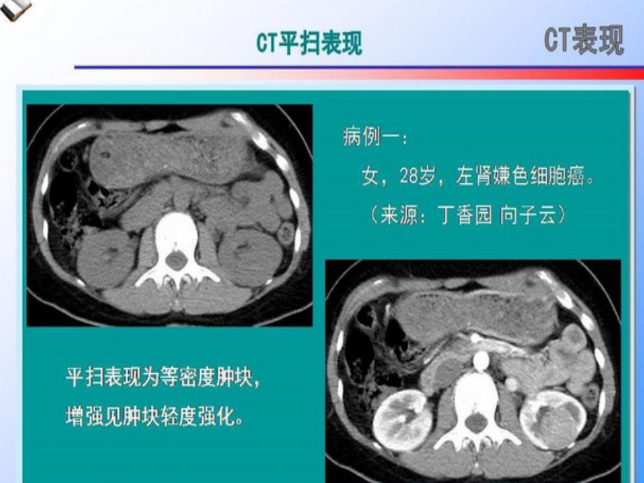 肾嫌色细胞癌的CT诊断和鉴别诊断ppt课件.ppt_第4页