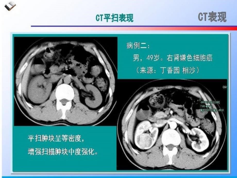 肾嫌色细胞癌的CT诊断和鉴别诊断ppt课件.ppt_第5页