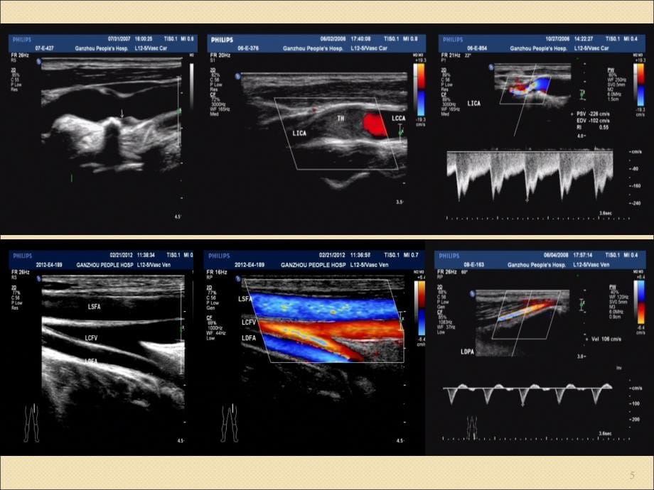 下肢血管超声规范检查与诊断ppt课件.ppt_第5页