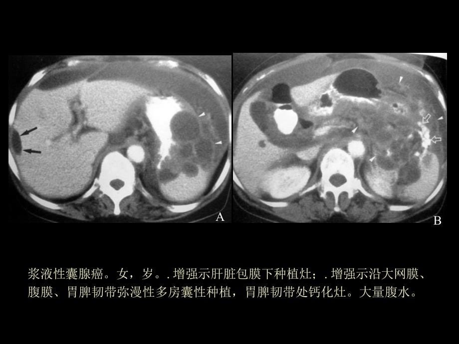 卵巢肿瘤的影像诊断及鉴别诊断_第5页