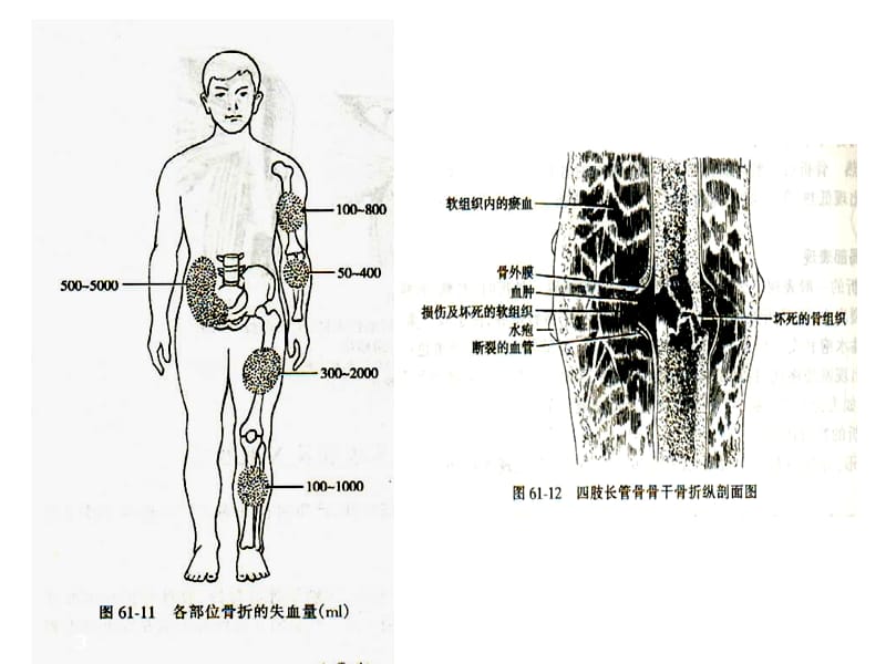 四肢骨折经典ppt课件.ppt_第3页