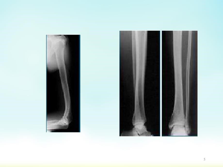 医学影像技术之上肢X线摄影ppt课件.pptx_第5页