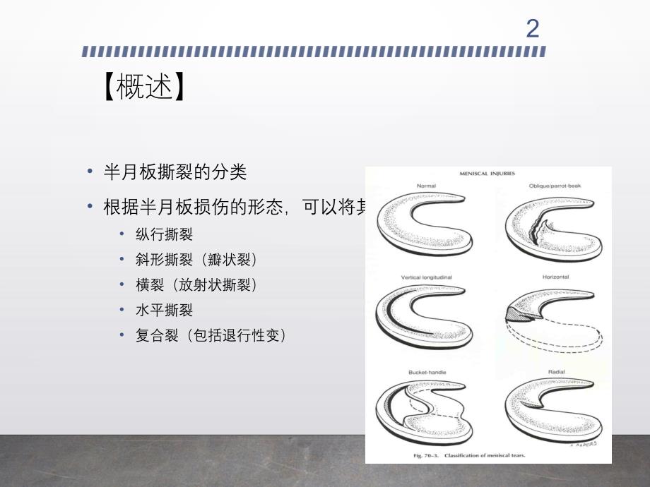 半月板撕裂的治疗_第2页