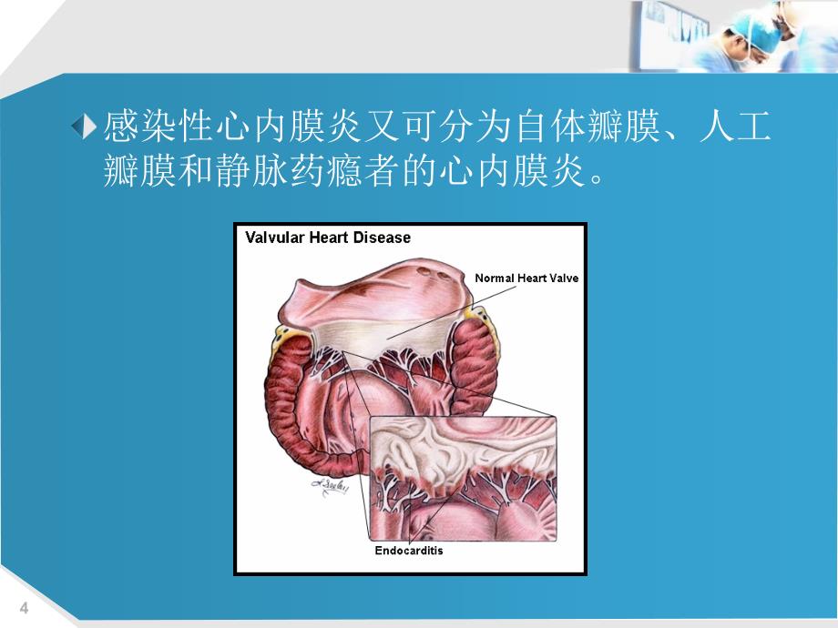 课件感染性心内膜炎PPT课件_第4页