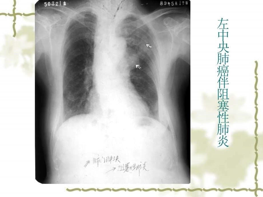 呼吸系统影像教学片五 (NXPowerLite)_第5页