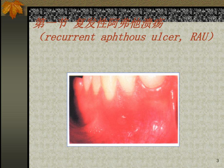 口腔粘膜病PPT课件_第3页