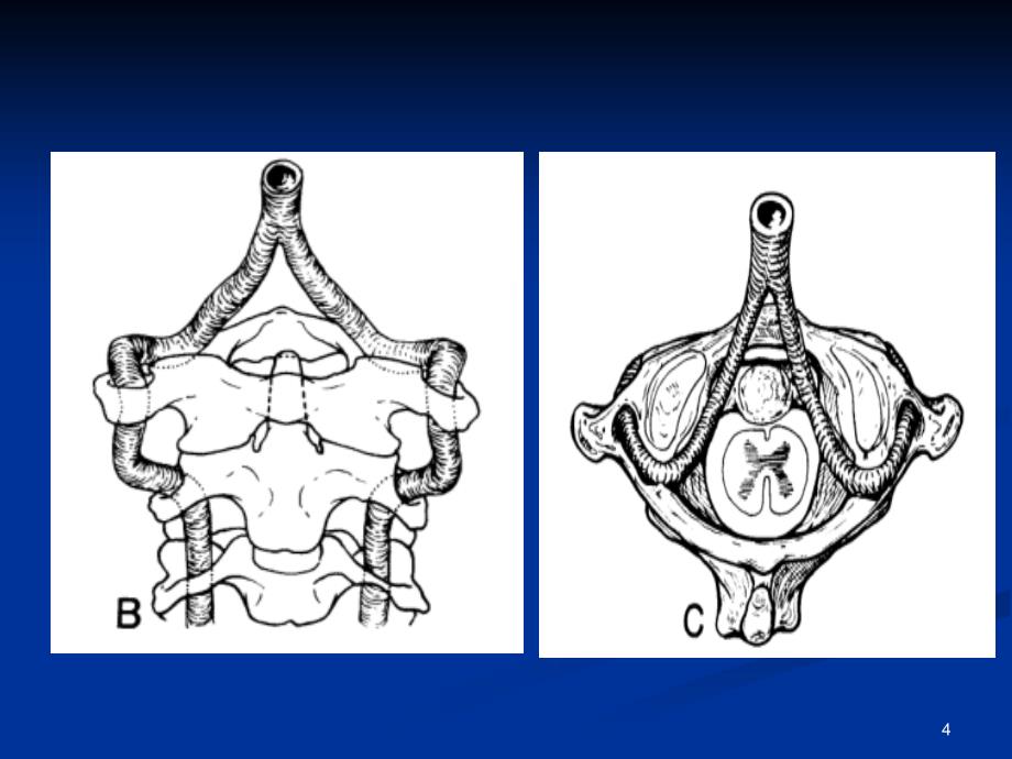 寰椎后桥PPT课件_第4页