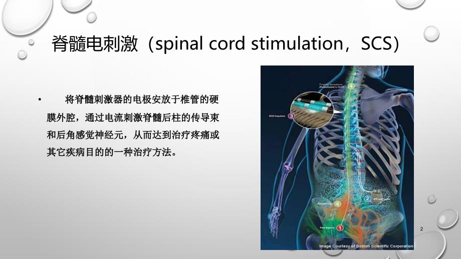 脊髓电刺激治疗的研究进展PPT课件_第2页