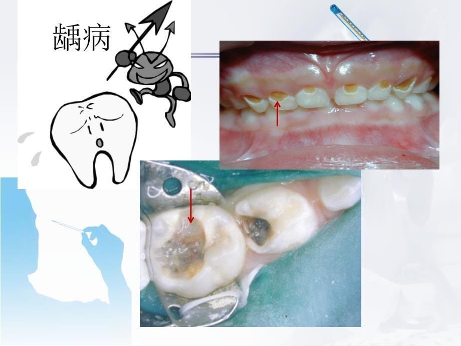 口腔常见疾病的防治PPT课件_第5页