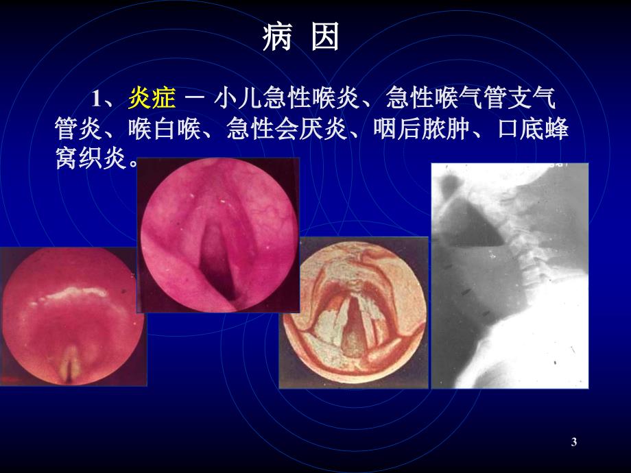 喉阻塞PPT课件_第3页