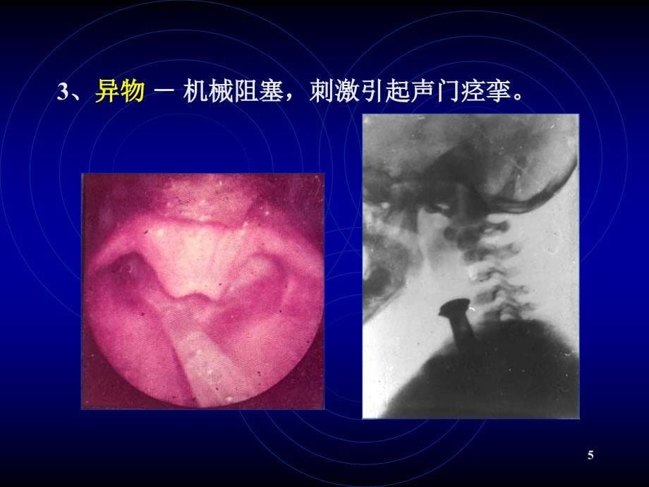 喉阻塞PPT课件_第5页