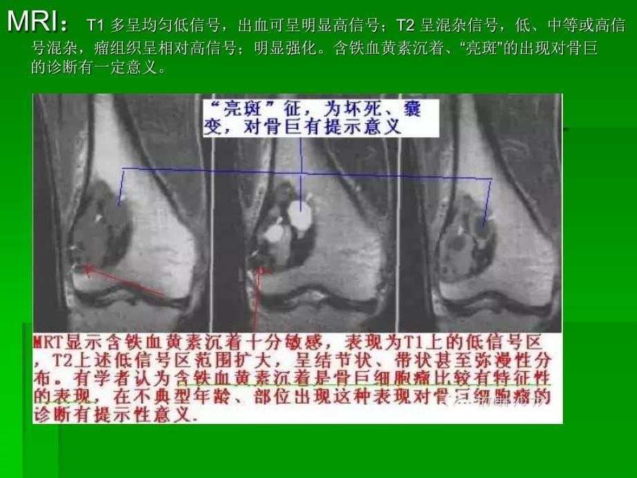 长骨偏心膨胀性病_第5页