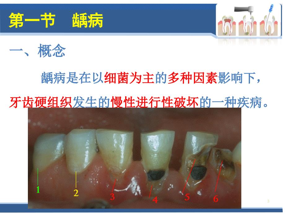口腔科学第四章牙体牙髓病PPT课件_第3页